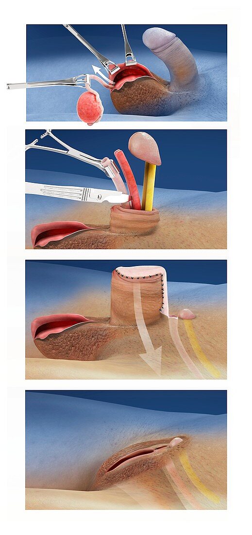 Male-female sex change operation, illustration