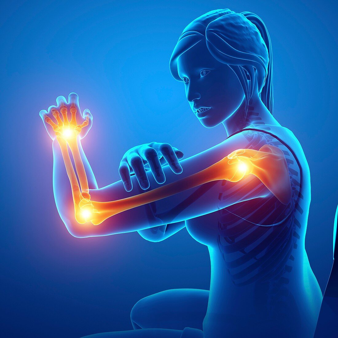 Woman with arm pain, illustration