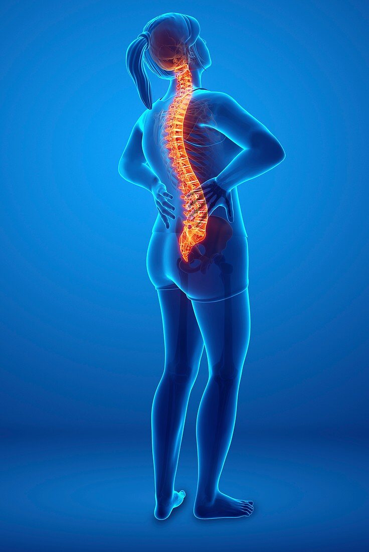 Woman with back pain, illustration