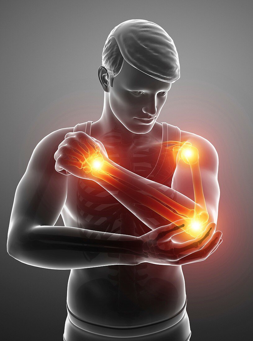 Man with arm pain, illustration