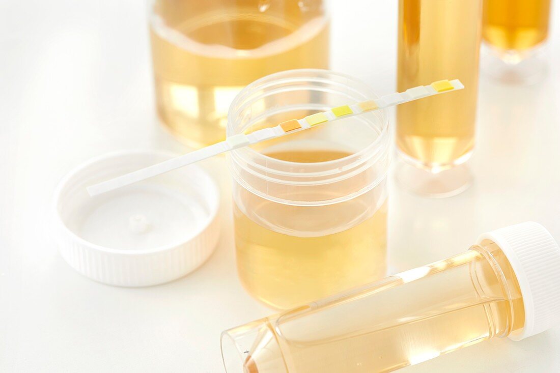 Urine samples for analysis and test strip