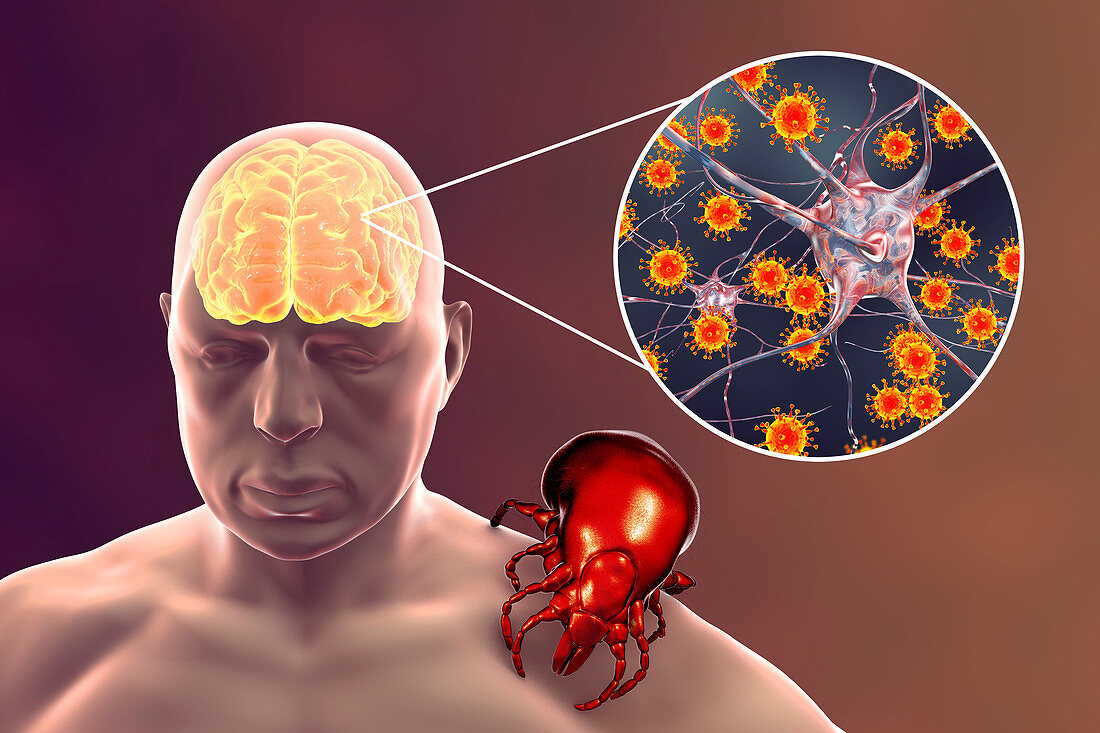 Tick-bourne encephalitis, illustration