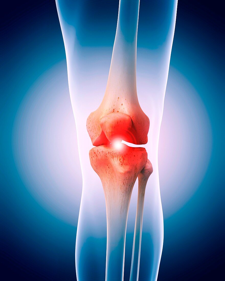 Human knee pain, illustration