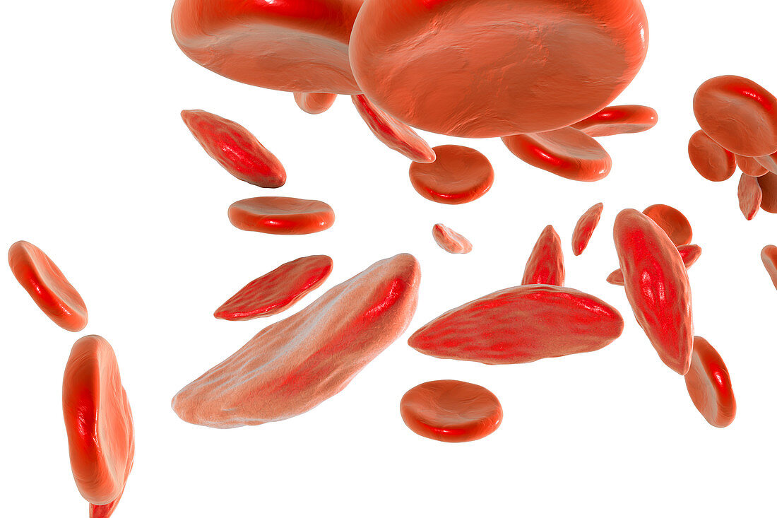 Sickle cell red blood cells, illustration