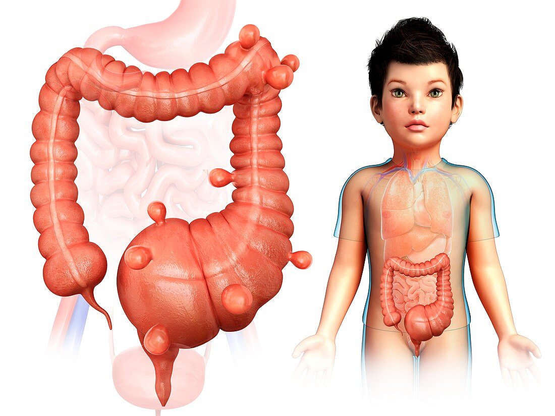 Child with megacolon and diverticulosis, illustration