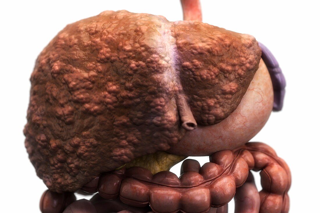 Liver Cirrhosis, artwork