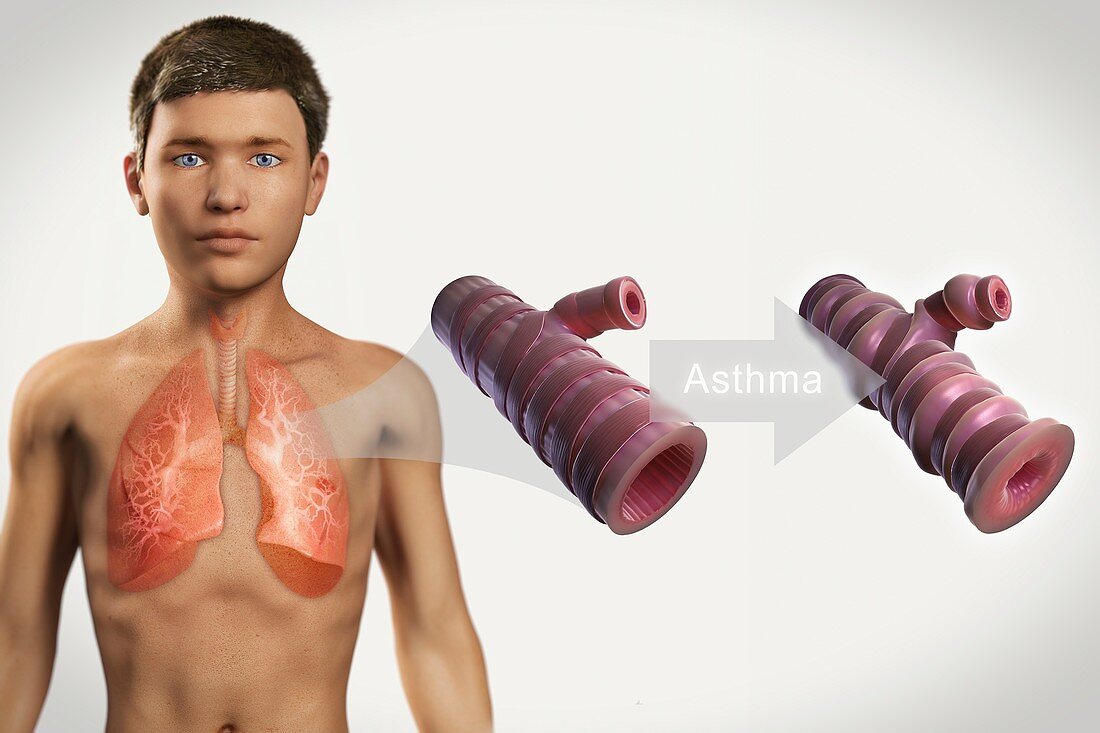 Asthmatic Airway, artwork