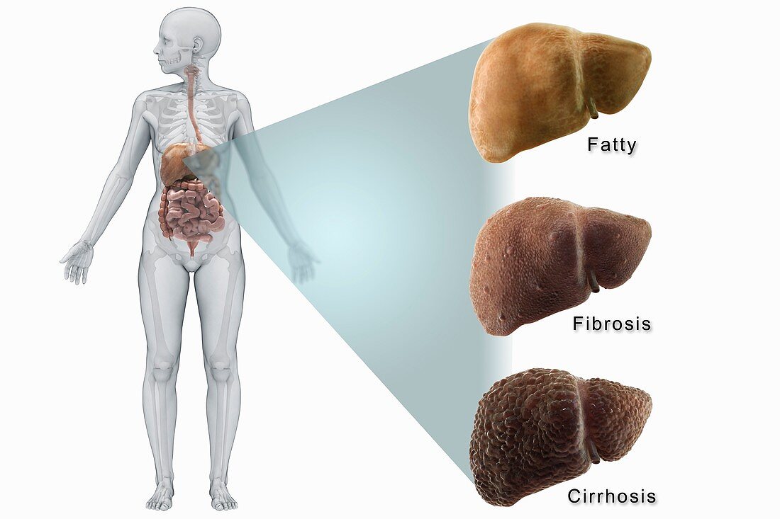 Stages of Liver Disease, artwork