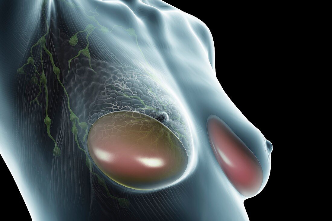 Breast Implants, artwork