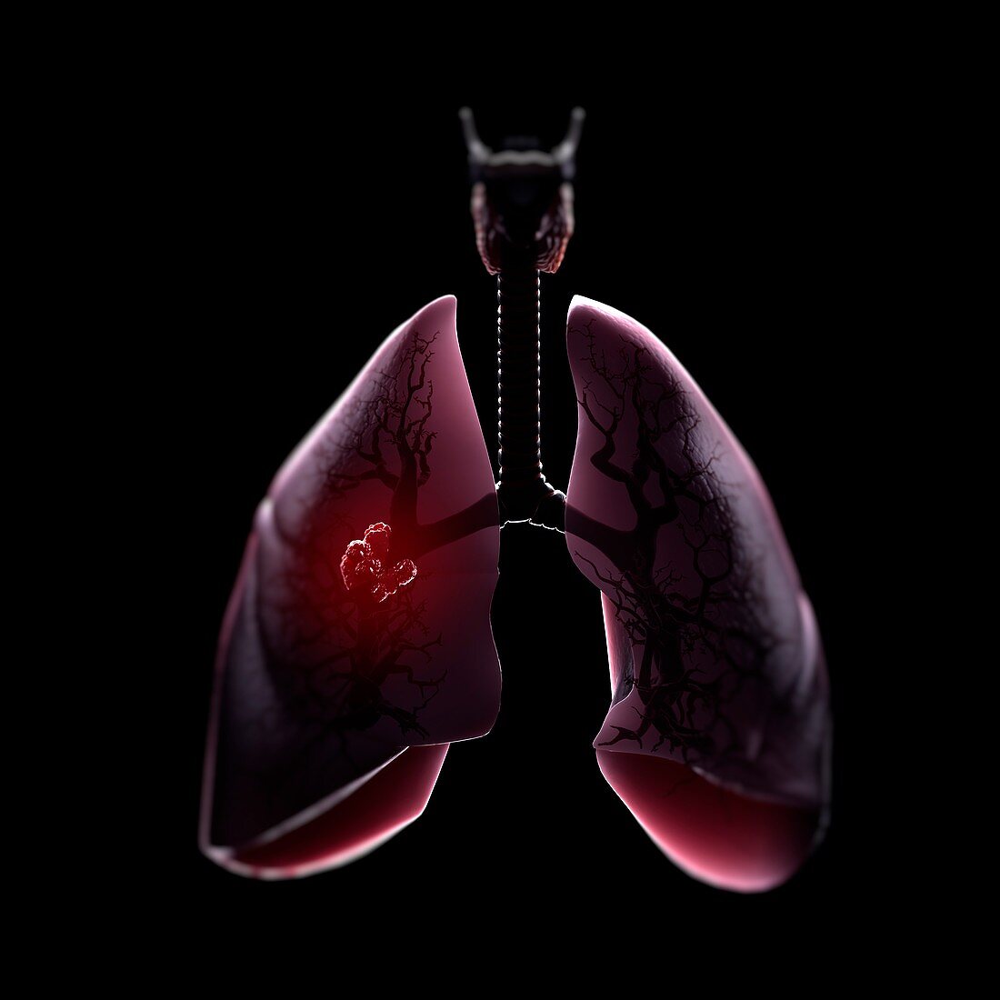Lung Tumor, artwork
