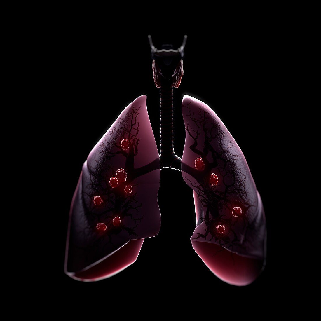 Multiple Lung Tumours, artwork