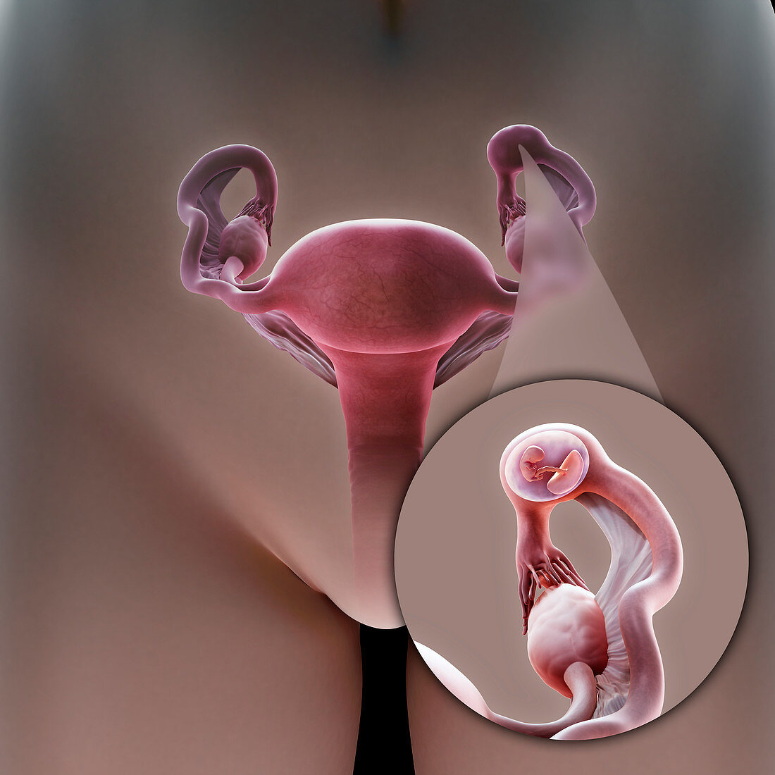 Ectopic Pregnancy, illustration