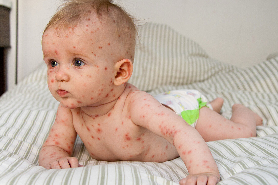 Baby with chickenpox