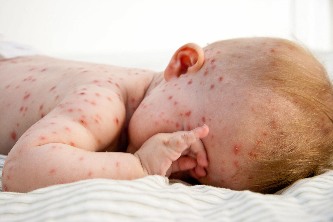 Baby with chickenpox