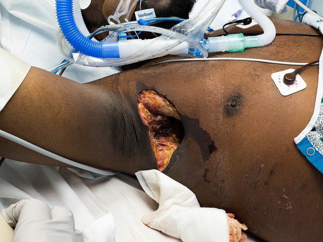 Axillary abscess in a septic shock patient