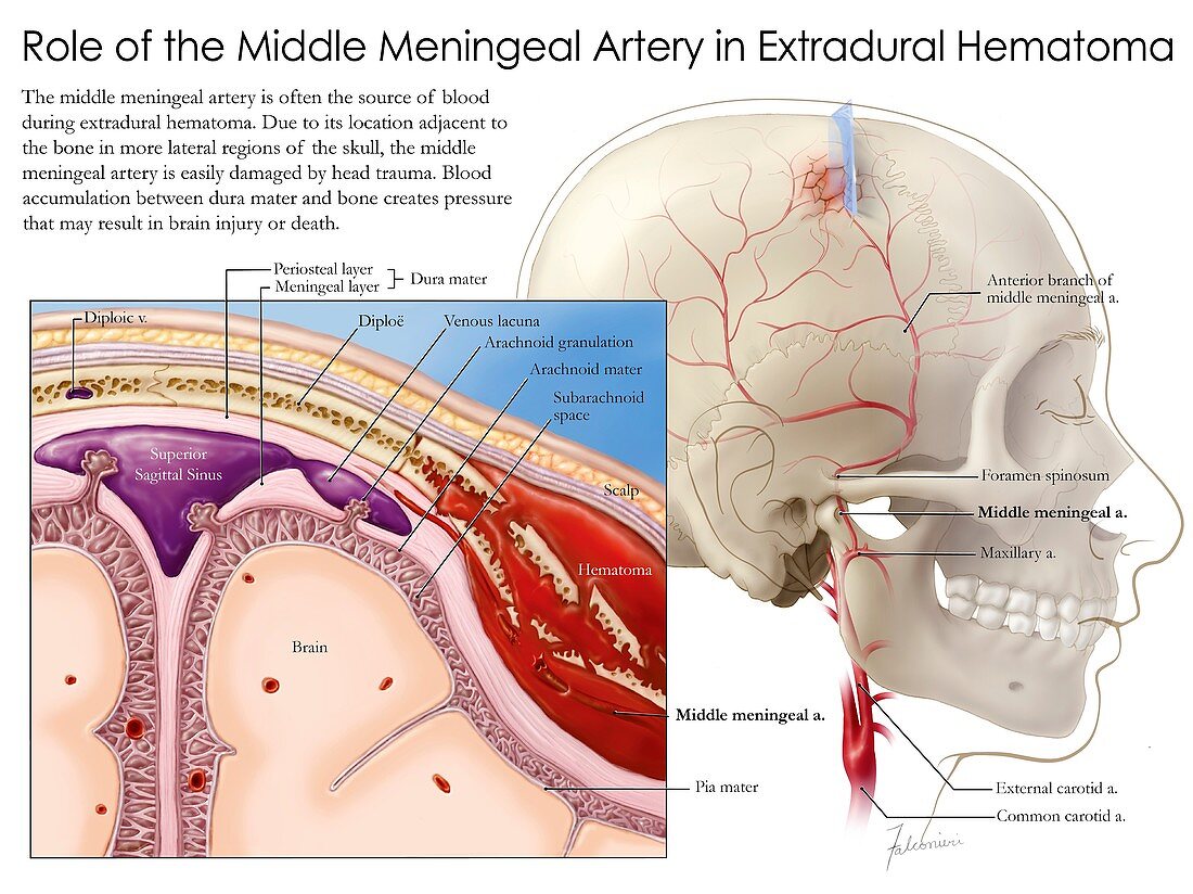 Middle meningeal artery and haematoma, illustration