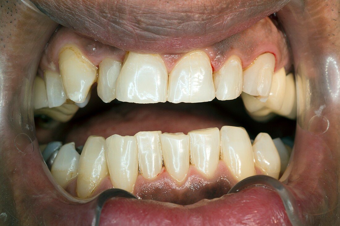 Teeth after whitening