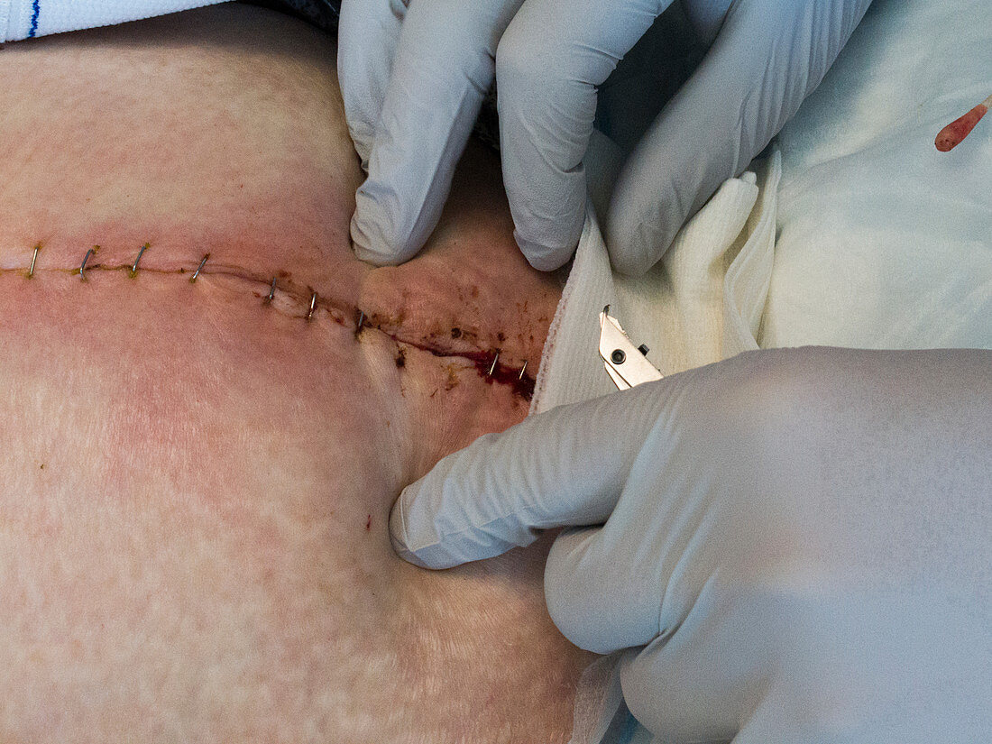 Cleaning infected surgical wound