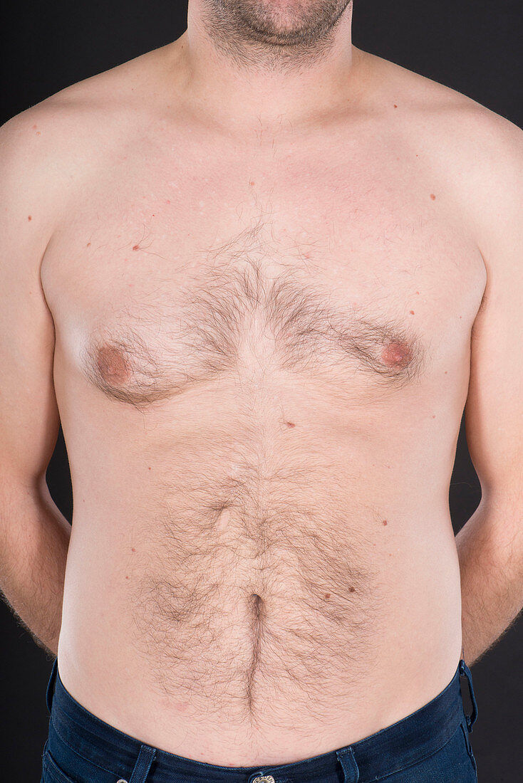 Enlarged male breast