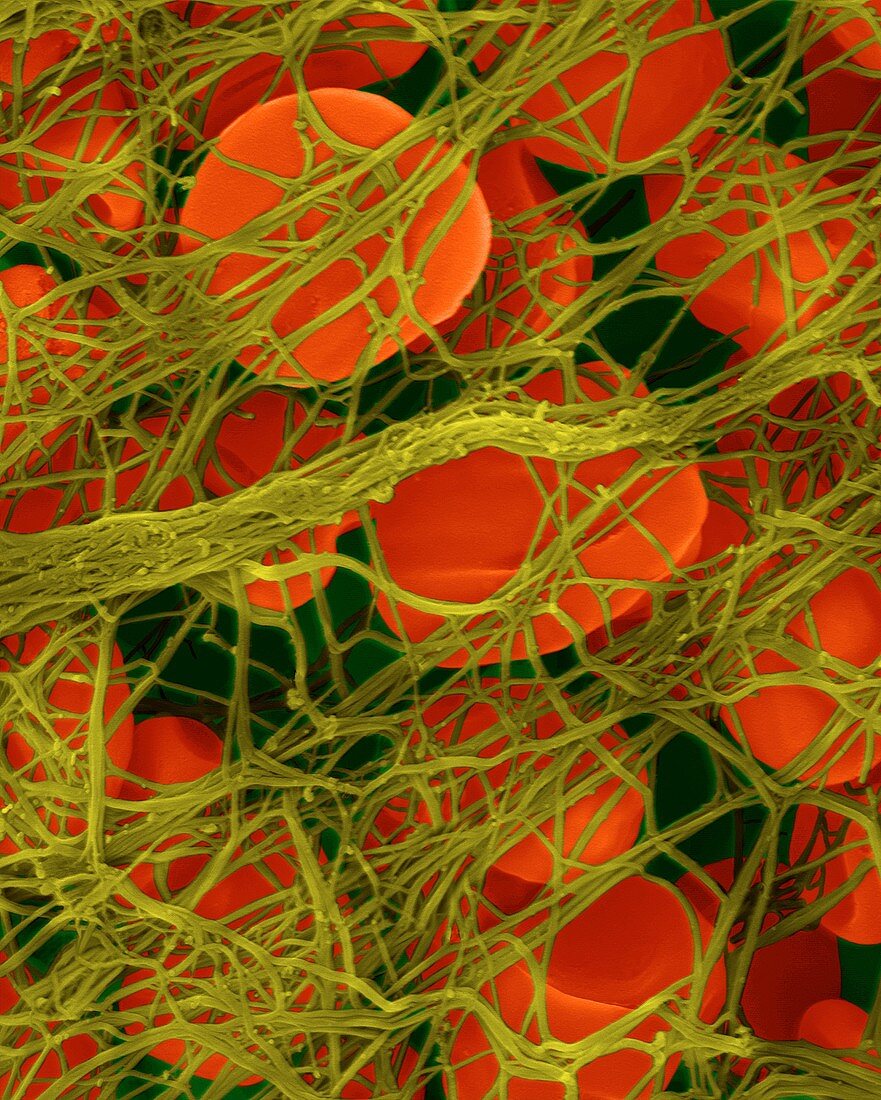 Red blood cells in a blood clot, SEM