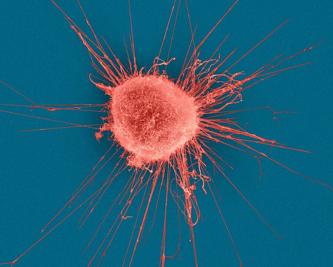 Breast epithelial cancer cell, SEM