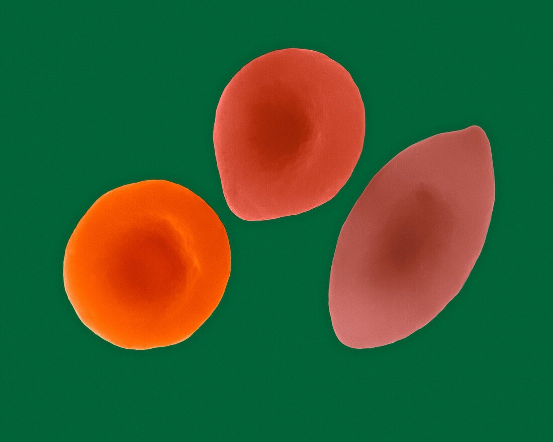 Healthy, intermediate, and sickle red blood cells, SEM