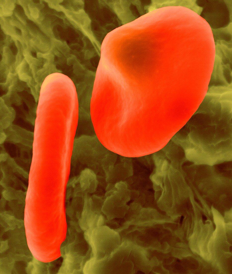 Red blood cell with the malaria parasite, SEM