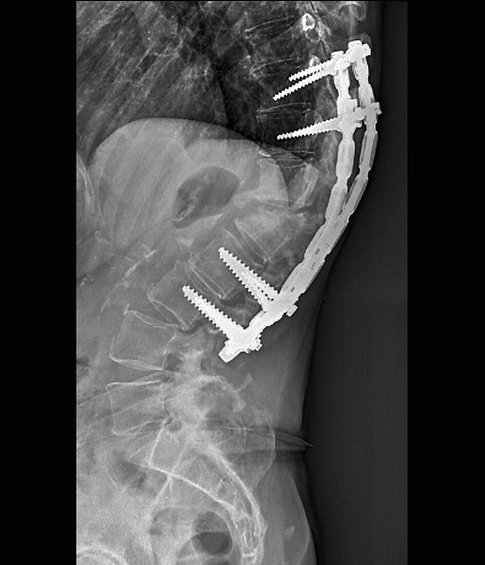 Spinal implant in kyphosis, X-ray