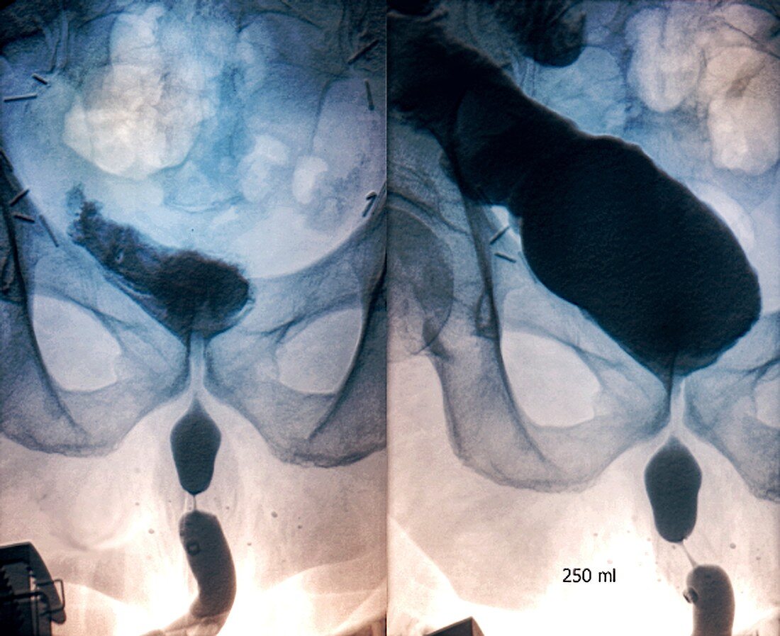 Augmented bladder, retrograde cystography