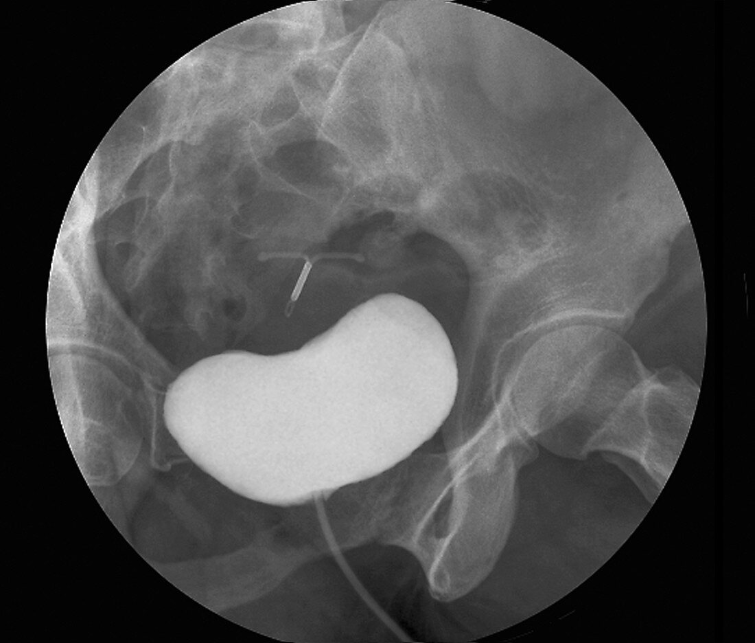 Weak bladder, retrograde cystography