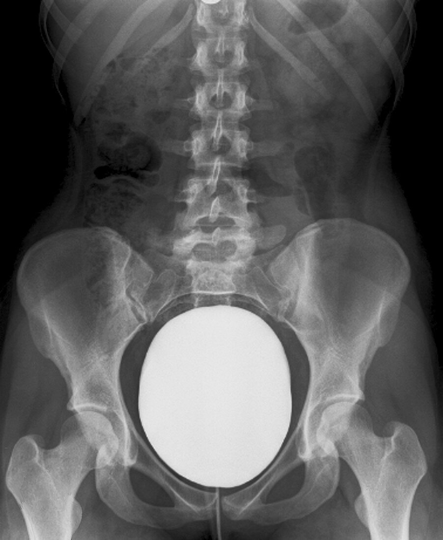 Urinary bladder examination, X-ray