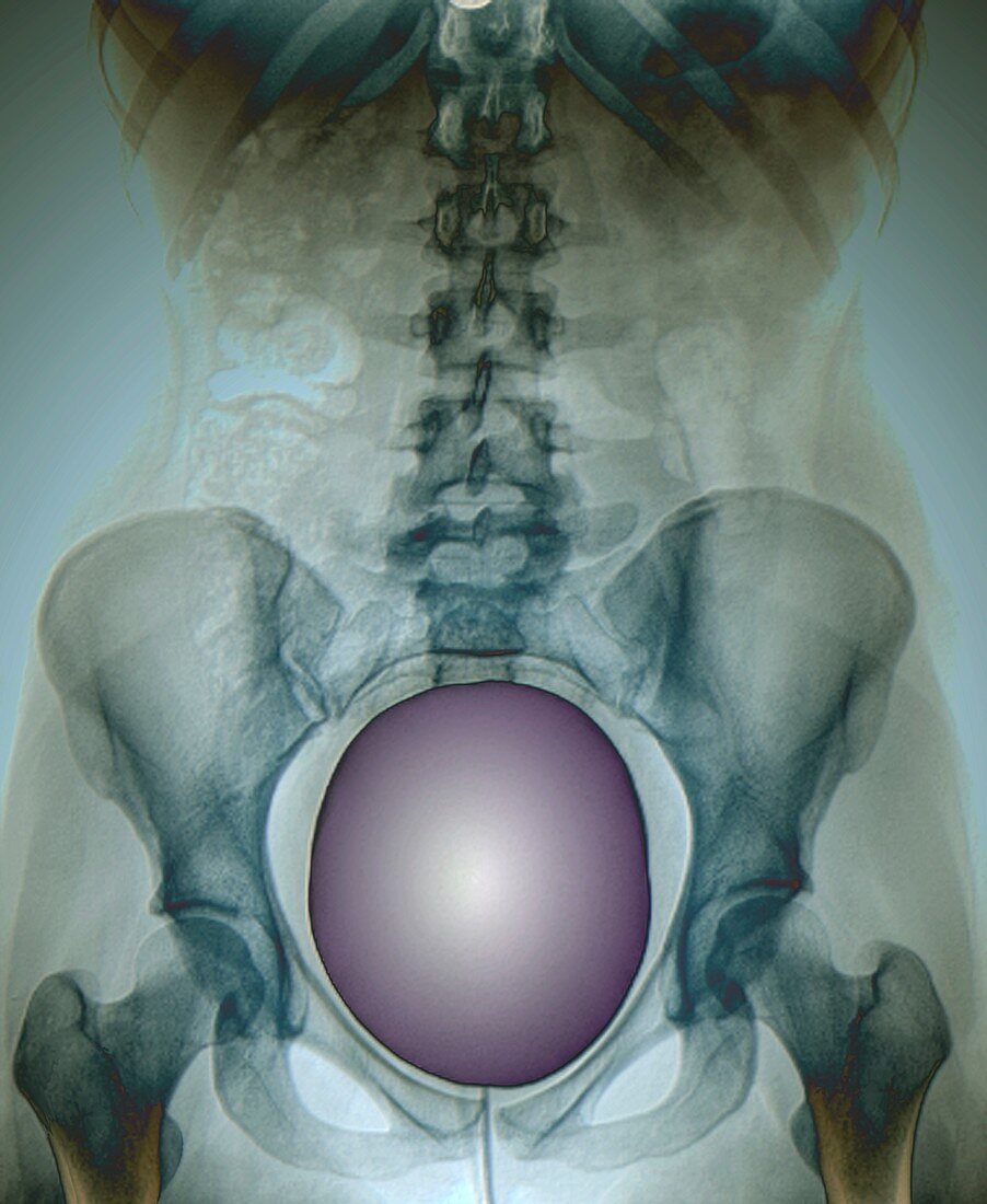 Urinary bladder examination, X-ray