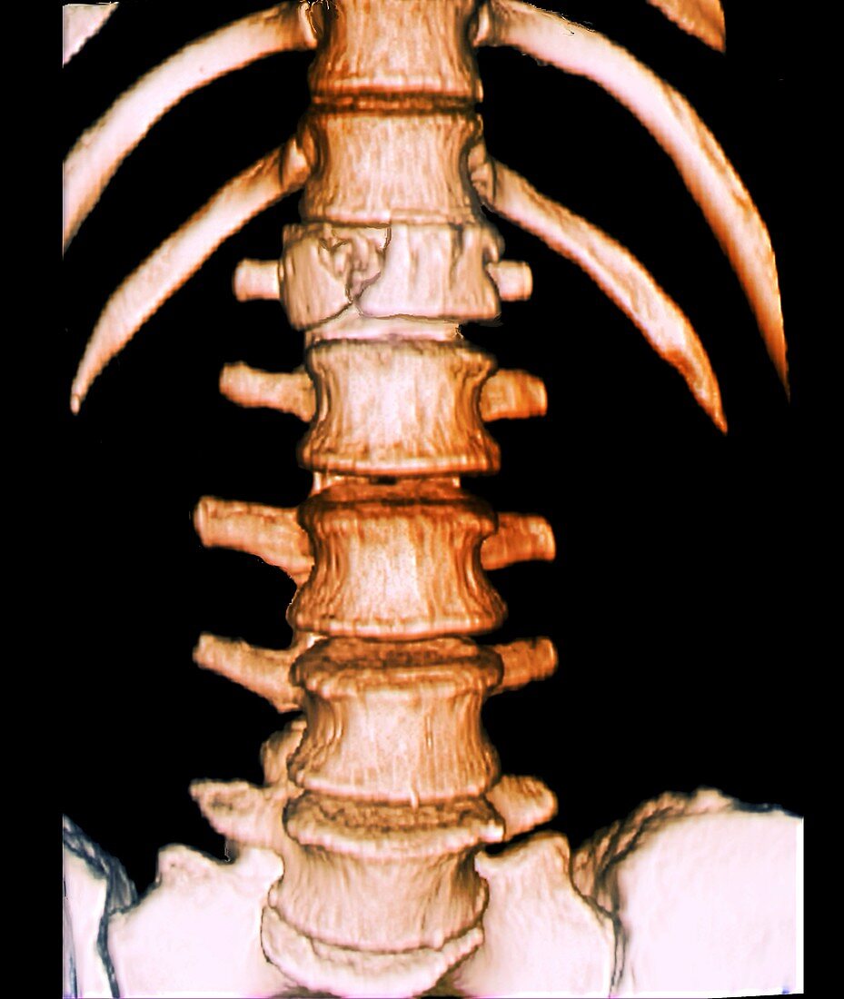 Fractured vertebra, 3D CT scan