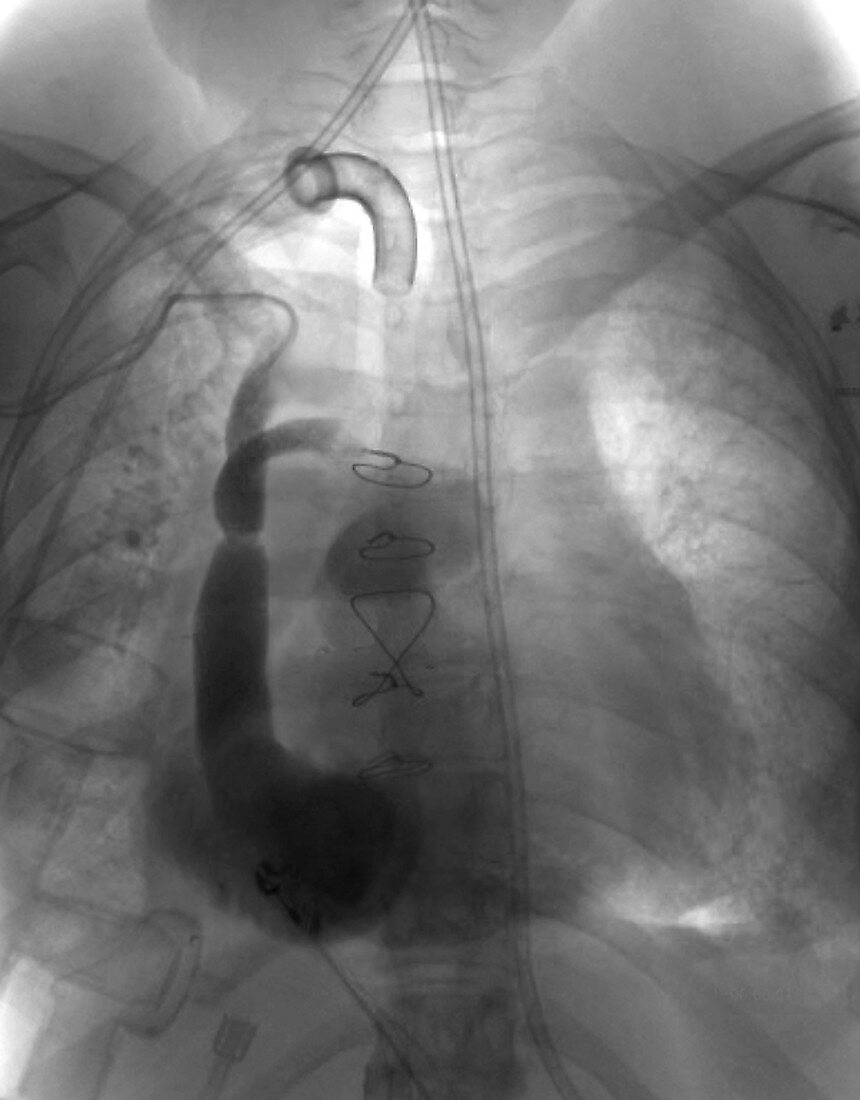 Heart transplant, X-ray