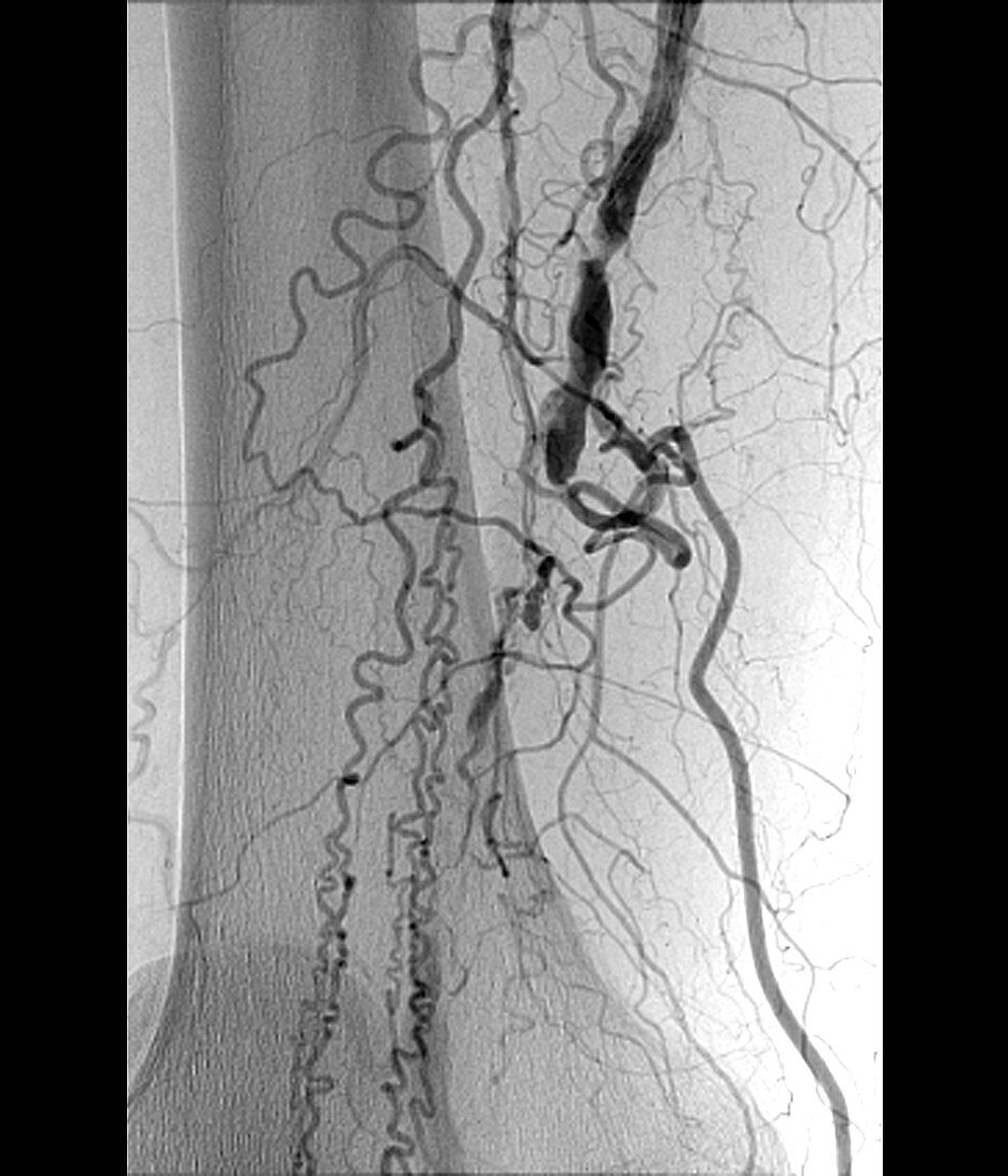 Blocked femoral artery, X-ray