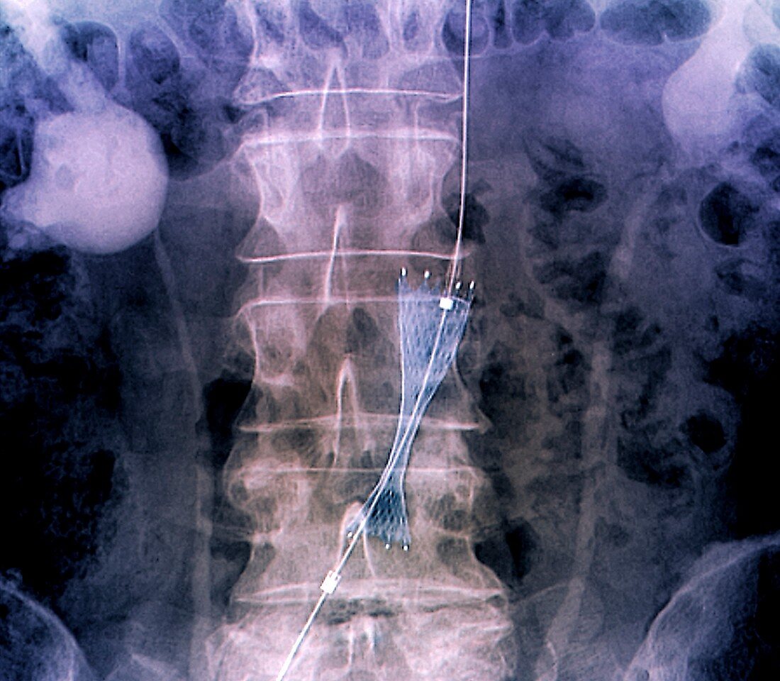 Implantation of stent in aorta, X-ray