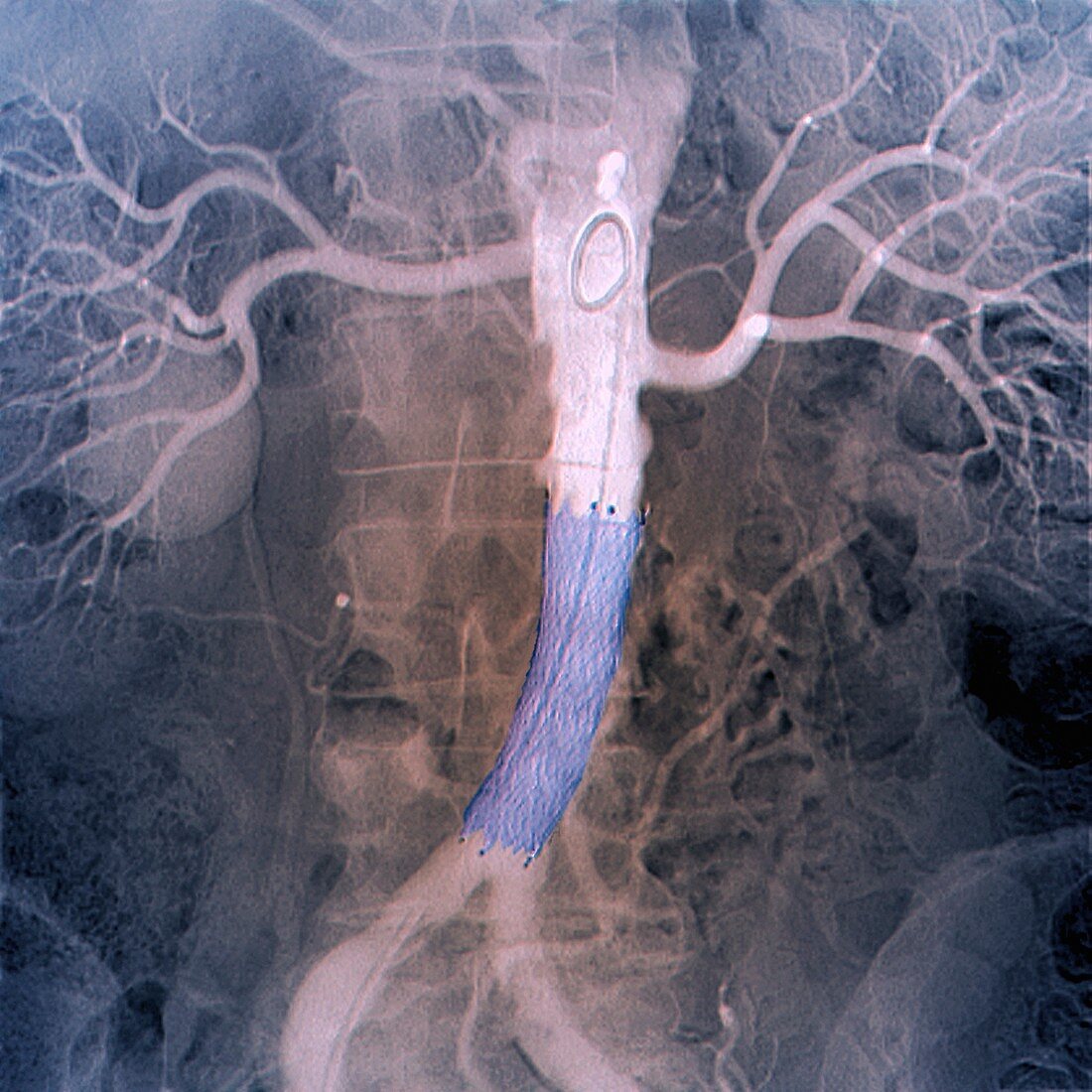 Final position of stent in aorta, X-ray