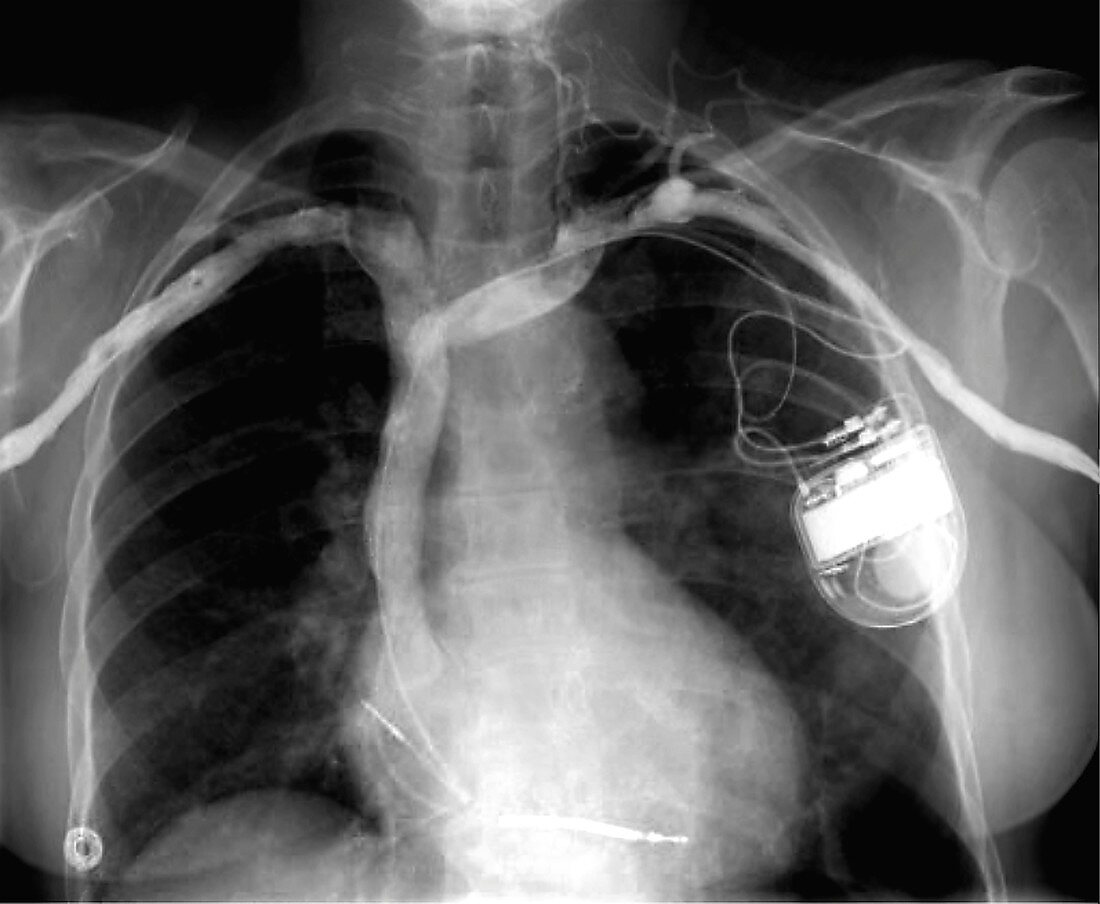 Cardiac pacemaker, chest X-ray