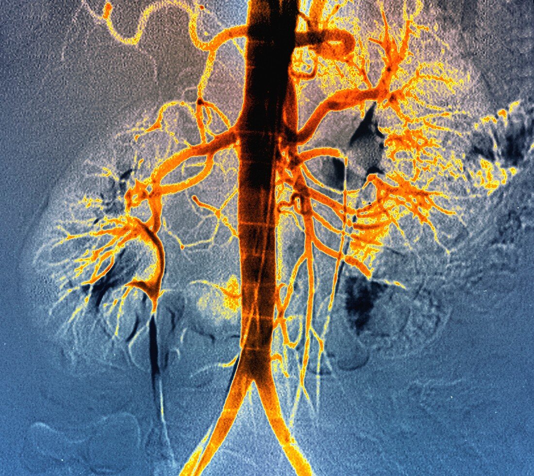 Kidney blood vessels, angiogram