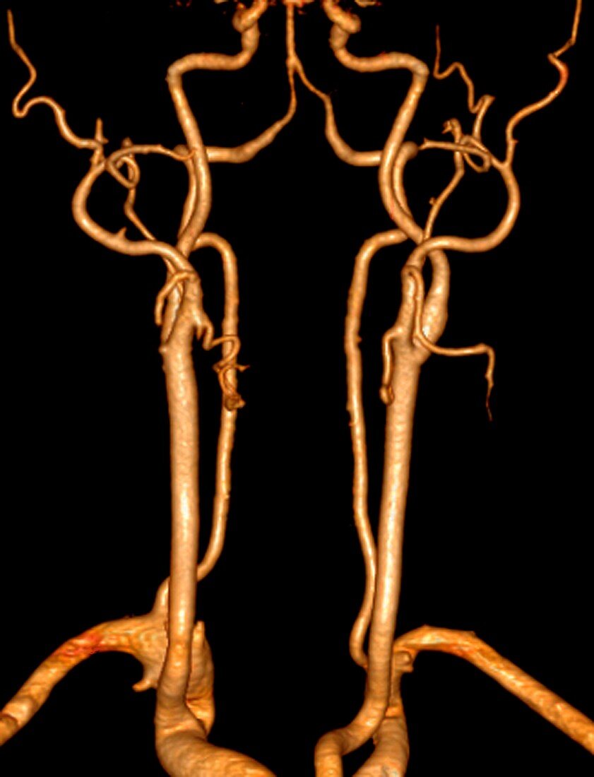 Neck arteries, 3D CT scan
