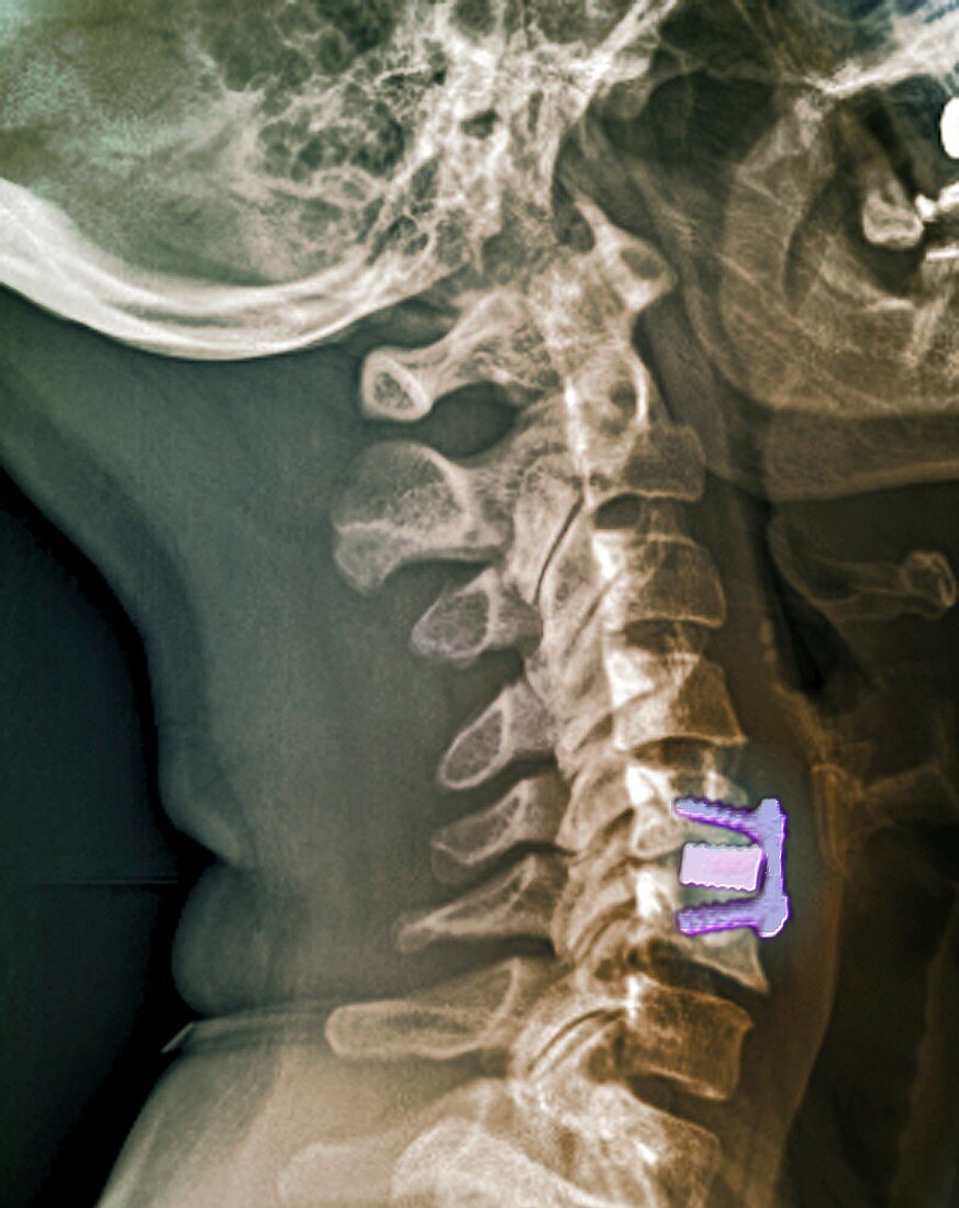 Cervical intervertebral disc implant, X-ray
