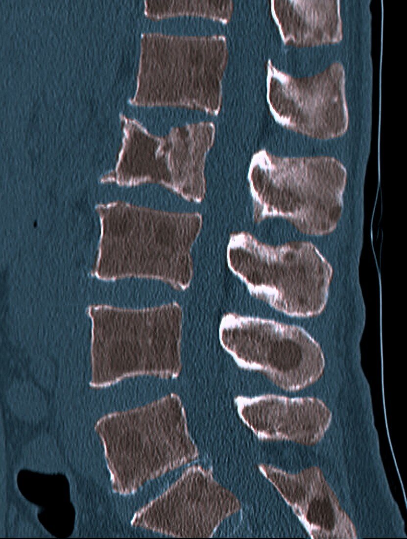 Secondary bone cancer in the spine, CT scan