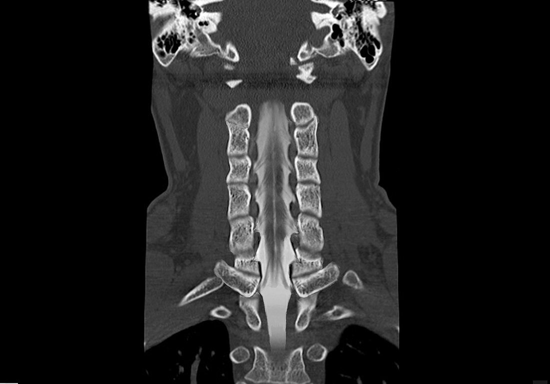Neck bones and spinal cord, CT scan