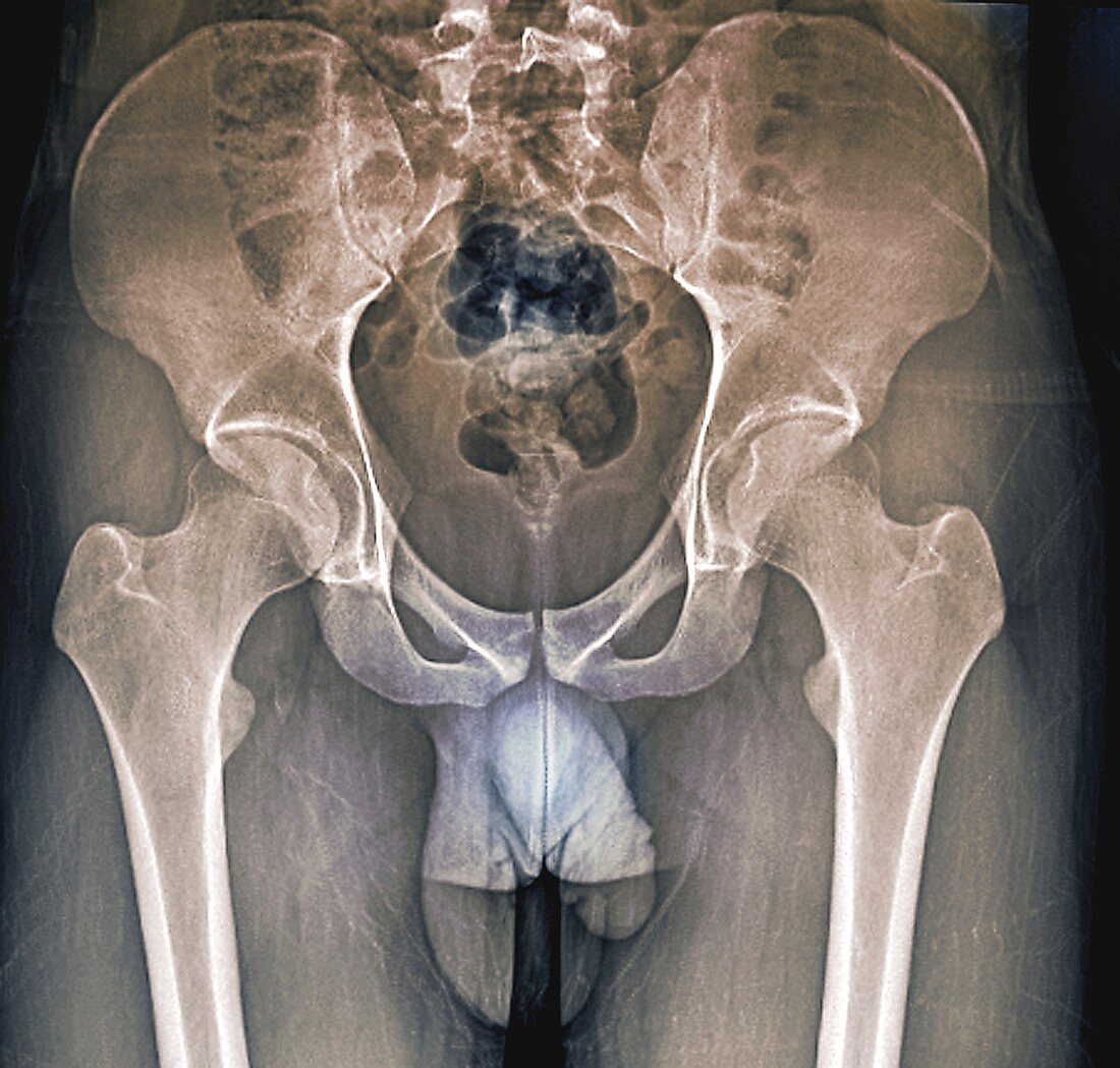 Male pelvis bones and joints, X-ray