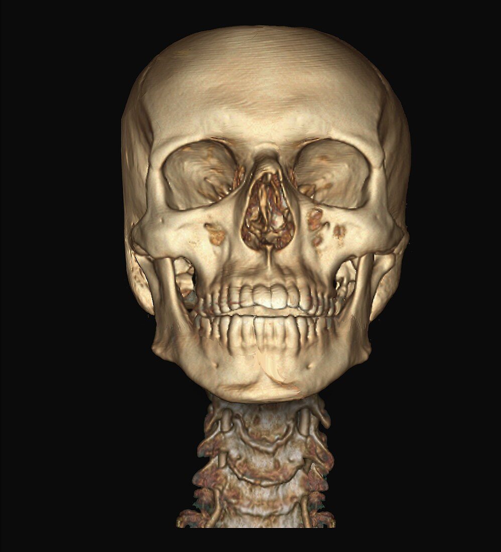Human skull and spine, 3D CT angiogram