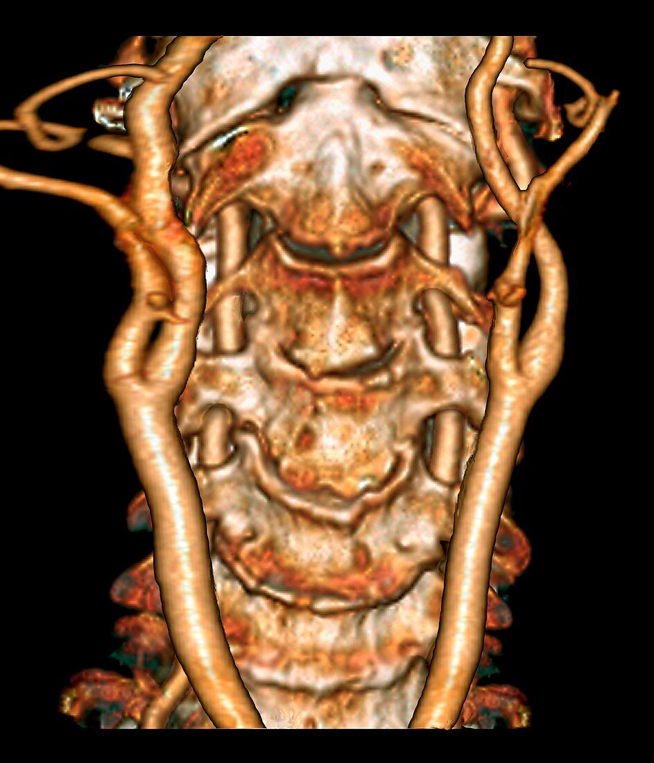 Cervical spine and arteries, 3D CT angiogram