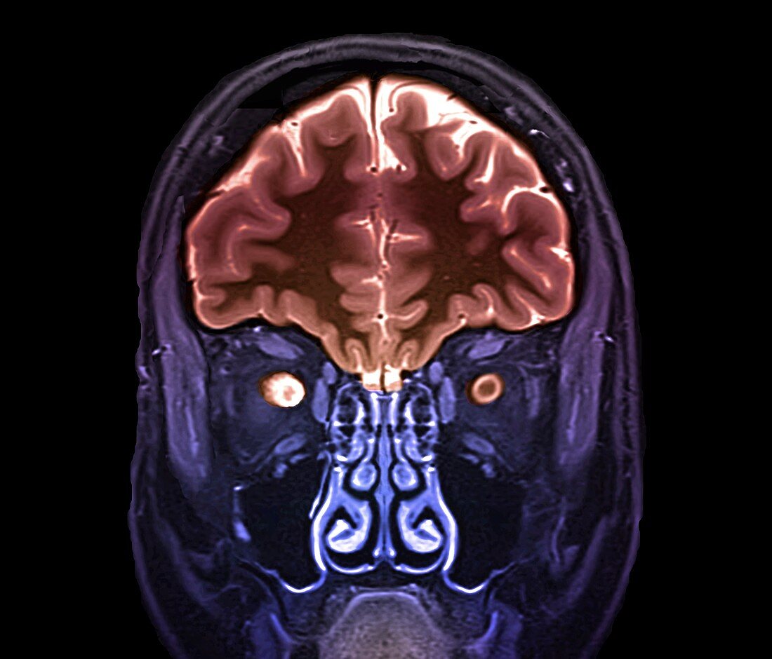 Optic nerve multiple sclerosis symptom, MRI scan