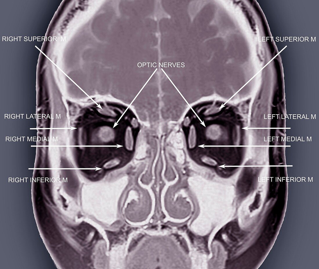 Eye anatomy and muscles, MRI scan
