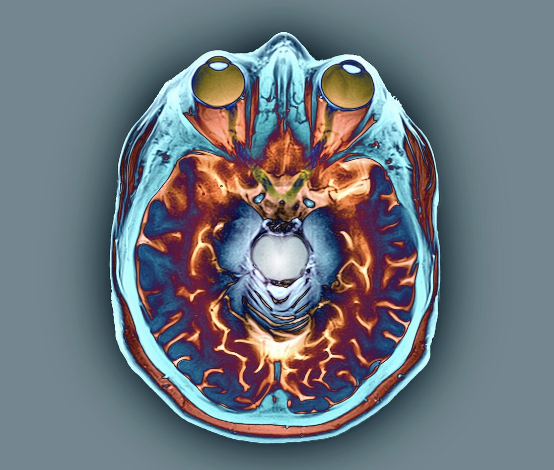 Human eyes and brain, MRI scan