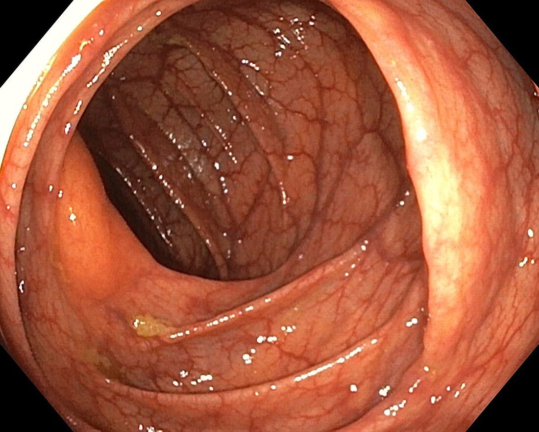 Healthy colon, endoscope view